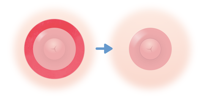 乳輪の外側を縮小する方法