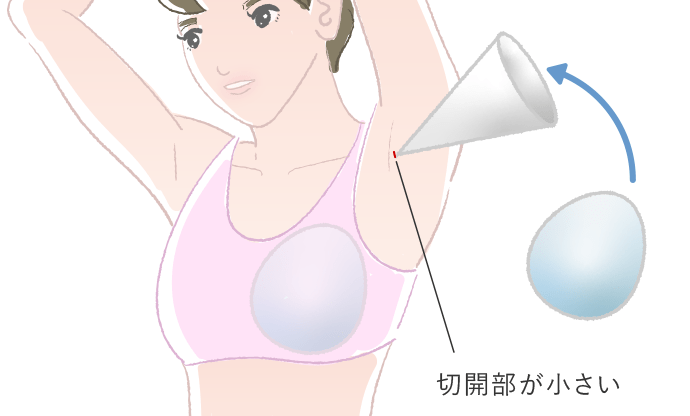 ケラーファンネルを使用